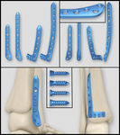 医疗器械 医疗钢板