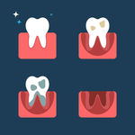 牙科医院牙齿蛀牙拔牙示意图