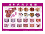 宫颈糜烂妇科疾病示意图