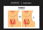 矢量医学甲状腺结节图解插画