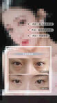 祛眼袋案例