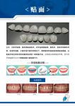 口腔 牙贴面