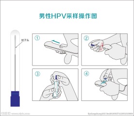 男性HPV取样