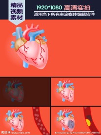 冠心病动脉血管硬化阻塞动画演示