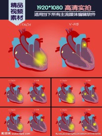 室性心动过速心室颤动对照演示动