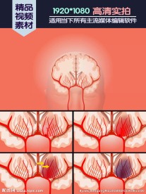 脑溢血医学演示动画