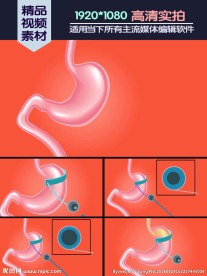 胃束带手术动画演示