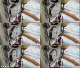 病人输血血液净化器