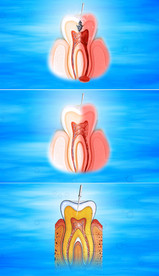 牙齿修复过程视频模板