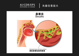 矢量医学鼻窦炎图解插画