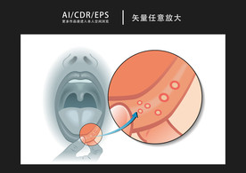 矢量医学口腔溃疡图解插画