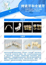 烤瓷牙全瓷牙