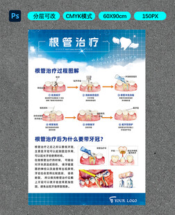 根管治疗